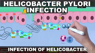 Helicobacter Pylori Pathogenesis | Detailed