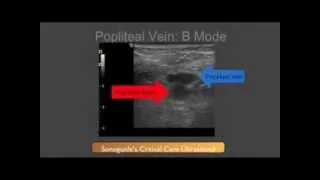 Basic Scanning Technique for Bedside DVT Ultrasound