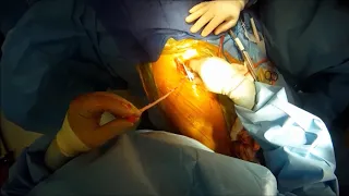 Peripheral Bypass Surgical Video_ML0841.000
