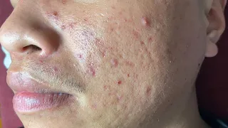 Huong Da Nang Acne Treatment #266