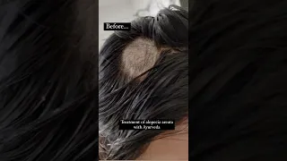 Treatment for Alopecia areata with Ayurveda | Dr. Rekha