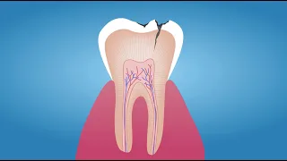 The Tooth Decay Process: How to Reverse It and Avoid a Cavity. Tips for Parents.