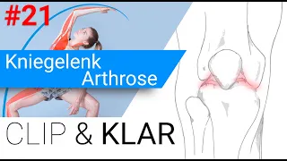 Kniegelenk Arthrose erklärt - Der Schmerz zwingt in die Knie