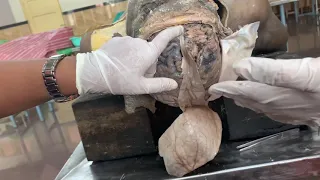 Dissection  Removal of brain