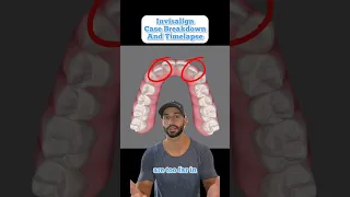 Invisalign Case Breakdown And Timelapse For A Young Professional. 2023