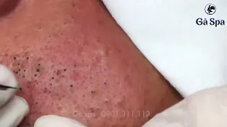 Best Blackhead Removal Ever 55min   Facial Acne Treatment   Gà Spa relaxar para dormir