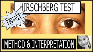 (हिन्दी) Hirschberg Test  कैसे करें | Squint Examination