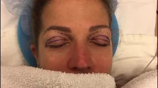 Upper Eyelid Lift to Remove Droopy Skin!