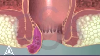 Thrombosed External Hemorrhoid - 3D Medical Animation