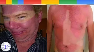 Most Unfortunate And Hilarious Sunburn | Summer Tanning Fails