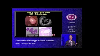 Gastric and Duodenal Polyps: Nuisance or Nuance?