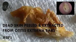 571 - Dead Skin Peeled & Extracted From Infected Otitis Externa Ears