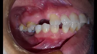 O QUE ACONTECE SE VOCÊ PERDER UM DENTE? SÉRIAS CONSEQUÊNCIAS!