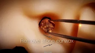 ASMR Remove hard stone earwax!! Tingle and sound guaranteed👍(No talking)