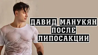 Давид Манукян | Экс-возлюбленный Бузовой | Фото после липосакции