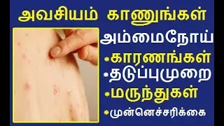 Chickenpox Signs and symptoms  in Tamil | Prevention & Treatment  for chickenpox