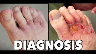 HORRIBLE FOOT RASH: Final Diagnosis & 2 Week Follow Up | Dr. Paul