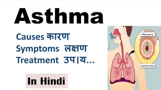 Asthma | Bronchial asthma | Causes, Symptoms, Diagnosis, Treatment, Prevention | Asthma in Hindi