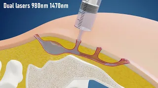 Sinus Laser Ablation Of Pilonidal Cyst SILAC - IBI Healthcare Institute