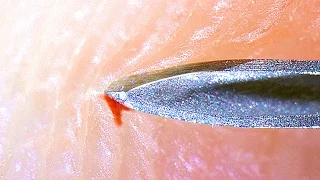 Needle pierces human skin - [under microscope]