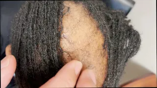 African-American Hair Loss: Traction Alopecia? No!!!!