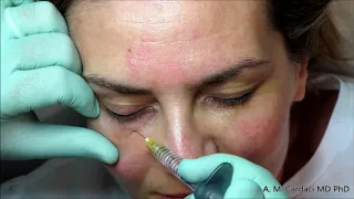 Nuova tecnica per trattamento delle occhiaie con filler - Dott. Aurelio M. Cardaci