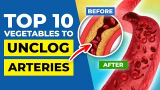 TOP 10 Vegetables to Unclog Arteries