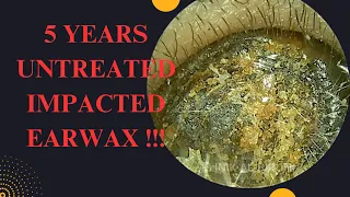 5 YEARS Untreated Impacted Earwax (Very Satisfying Result)