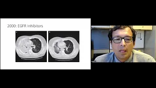 "Lung Cancer 25 Years Later" presented by Dr. Renato Martins