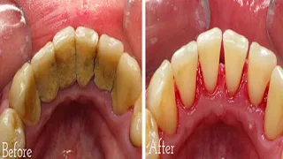 How to Remove Tartar Buildup FAST, how to remove tartar from teeth - how to remove dental plaque at