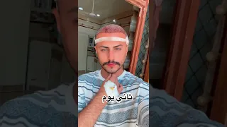 قبل وبعد عملية زراعة الشعر في العراق