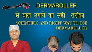 Dermaroller -hair fall treatment-बाल गिरने का इलाज - hair regrowth-Neo graft chandigarh-