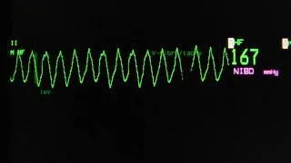 ventricular tachycardia - Torsade de Pointes on an ECG heart monitor