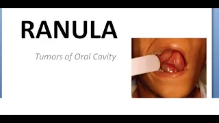 ENT Ranula Tumors of oral cavity Below tongue swelling mass round cyst plunging sublingual salivary