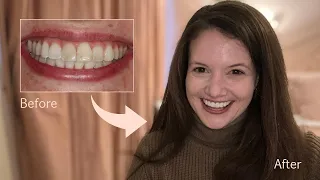 My smile makeover - Invisalign, whitening and composite bonding!