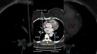 chest anatomy - Axial CT scan