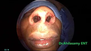 Surgical option for nasal Allergy and Nose block