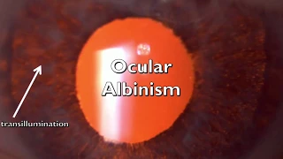 Ocular Albinism