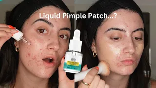 TESTING A LIQUID PIMPLE PATCH | Kiehls Truly Acne Targeting Solution 1 Week Test