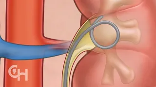 Ureteroscopy for Kidney Stones in Children