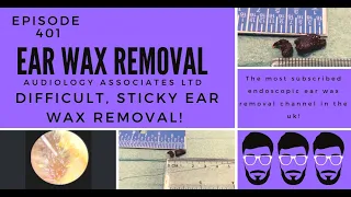 DIFFICULT, STICKY EAR WAX REMOVAL - EP401