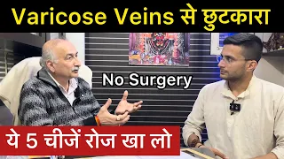 Varicose Veins Treatment in Ayurveda |  How to Cure Varicose Veins Problem | The Health Show
