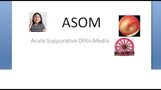ENT ASOM Acute Suppurative Otitis Media Necrotizing Cart wheel appearance middle ear infection