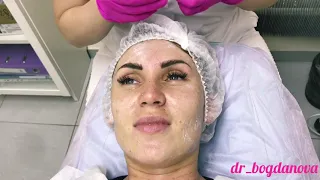 Мезотерапия лица препаратом Dermaheal HSR