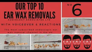 TOP 10 EAR WAX REMOVAL VIDEOS - NUMBER 6