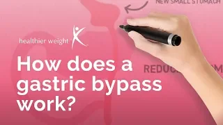 How does a gastric bypass work?