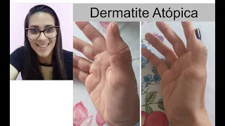 Bianca- Dermatite Atópica