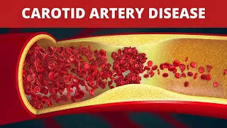 Treatment of Carotid Artery Disease