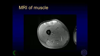 Imaging of muscle injury