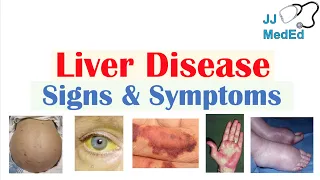 Liver Disease Signs & Symptoms (ex. gynecomastia, bruising) | Hepatic Stigmata
